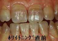 アルミ 白く 歯 を する ホイル 方法